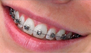 metalen-brackets